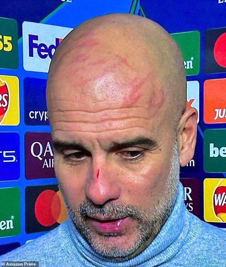 Guardiola appears with cuts and marks on face and jokes about ‘self-harm’