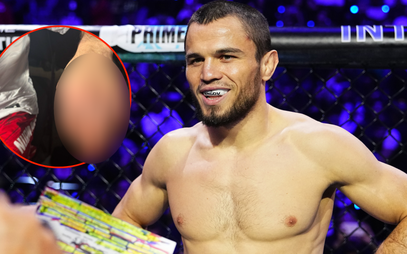 Umar Nurmagomedov shares graphic image of broken hand suffered against Merab Dvalishvili at UFC 311