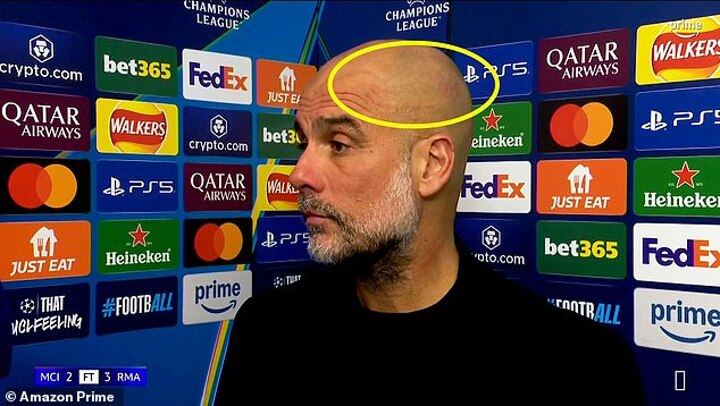 Pep Guardiola spotted with scratches on his head for the THIRD time this season