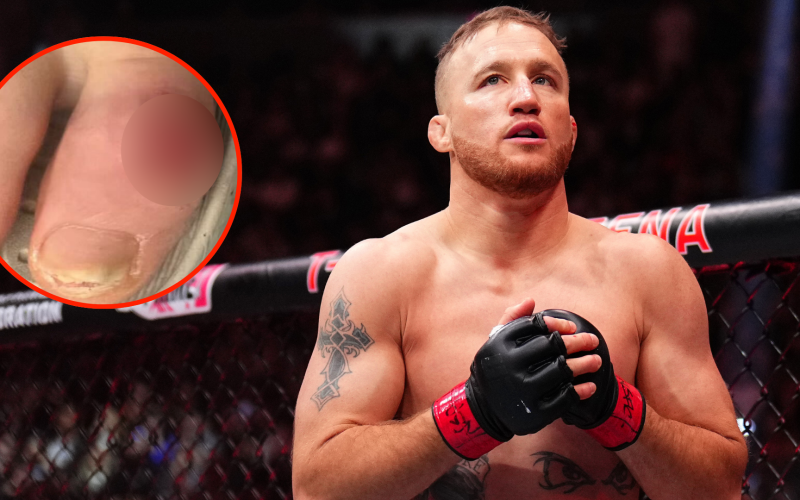 Justin Gaethje shows off gruesome injury one week after Rafael Fiziev UFC 313 rematch